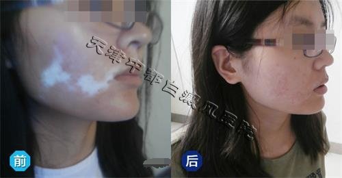 女性的白癜风患者发病有什么特点呢？