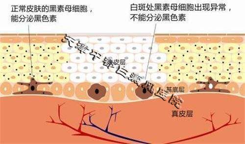 女性白癜风患者吃药会影响生育吗？